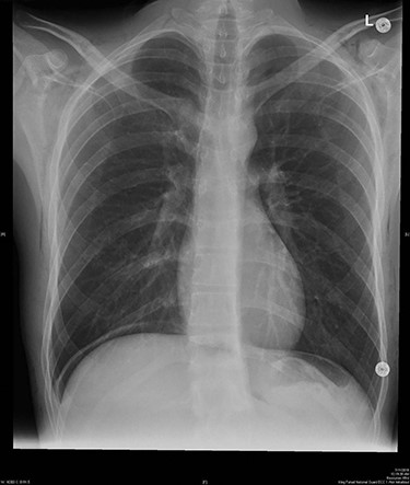 Final pre-discharged x-ray showed improvement of the SE compared to the intra-operative x-ray.