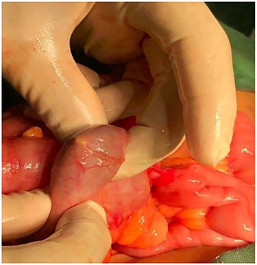 The migrated IUD has been identified inside the cecum.