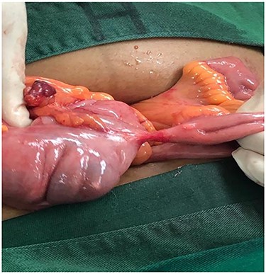 Ileocecal fistula has been identified at the base of the cecum at the entry point of the migrated IUD.