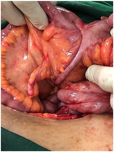 Normal appendix has been identified at a normal location and near to ileocecal fistula.
