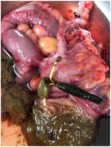 IUD in the resected bowel.
