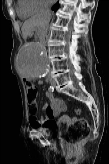 CT Aortogram demonstrating 8-cm infrarenal aneurysm.