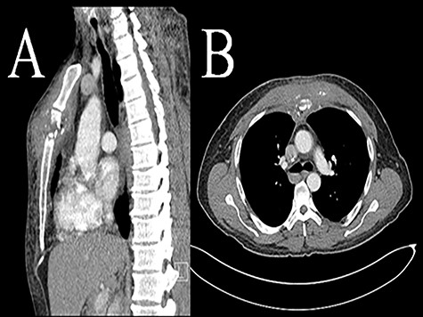 Computed tomography (CT scan) sternomanubrial joint bone erosion and phlegmon. Computed tomography (CT scan): A (sagittal view) and B (axial view).