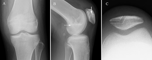 Radiographs of the left knee after MPFL reconstruction. Anteroposterior (A), lateral (B) and axial (C) radiographs of the left knee after MPFL reconstruction showing the entry of patella tunnel (white arrow), entry of femoral tunnel (white dot arrow) and bone tunnel of patella (white dot line). Patella tilt of post-operation was similar to that of pre-operation.