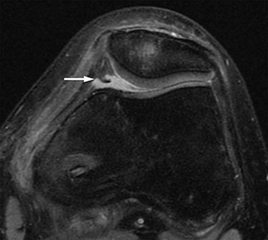 MRI. Axial proton density-weighted (TR = 3000, TE = 12) image before medial patellofemoral ligament (MPFL) reconstruction revealing medial synovial plica (white arrow). The medial patellofemoral joint space and the size of the medial plica after MPFL reconstruction are almost the same as before surgery. There are no clear signs of injury to the cartilage in the patellofemoral joint.