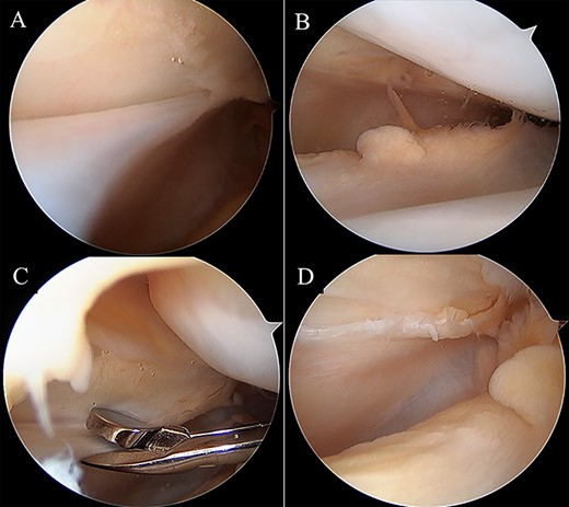 Intraoperative arthroscopic views. Medial synovial plica with a tight and hypertrophic margin (A). No injury to the patellar and femoral cartilage was observed (B). The synovial plica was partially removed with oval forceps (C). Image after removal (D).