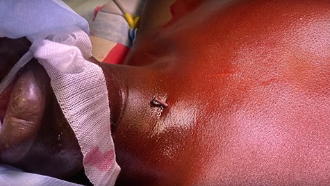 Image of Nail 1: externally visible penetrating anterior chest wall.