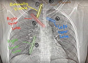 Chest X-ray: detailing the position of four nails within the thorax (Nail 2: right upper lobe; Nail 3: right lower lobe; Nail 4: left upper lobe) and Nail 5 (throat).