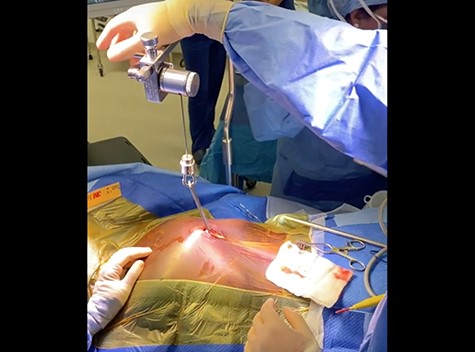 Image showing the sternum being lifted using a Rultract® Skyhook Retractor to allow good access to the pleural cavities.