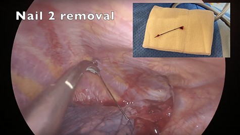 Nail 2 removal in the right upper lobe.