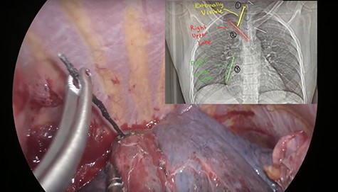 Nail 3 removal in the right lower lobe.