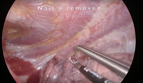 Nail 4 removal in the left upper lobe.