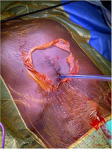 Single chest drain insertion after the operation.