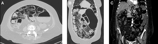 (A) Computed tomography (CT), revealing pneumatosis intestinalis on the bowel wall. (B) CT, revealing multiples gas-filled cysts in the bowel and on the mesentery. (C) CT, no evidence of gas in the portal system.