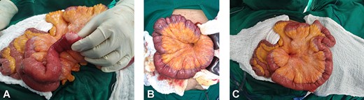 (A) Multiples gas-filled cyst on the serosa of the small bowel. (B) Multiples gas-filled cyst on the serosa of the small bowel and mesentery. (C) Multiples gas-filled cyst on the serosa of the small bowel and mesentery.