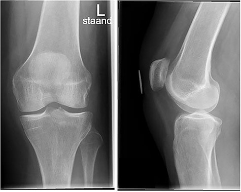 Conventional radiograph of the left knee shows no abnormalities.