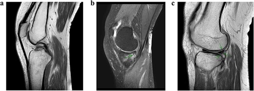 MRI scan of the left knee. (a) ACL rupture. (b) Small incomplete fracture of the posteromedial tibia plateau. (c) Partial lateral meniscal tear.