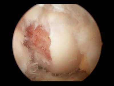 Knee arthroscopy showed an avulsion fracture from the ACL of the lateral femoral condyle.