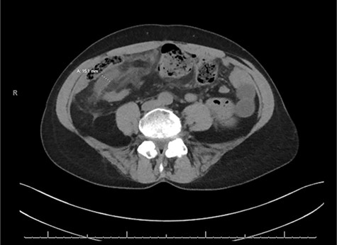 Axial slice of the CT of the abdomen/pelvis demonstrating a dilated appendix up to 1.5 cm in size with mesenteric edema in the right lower quadrant of the abdomen.