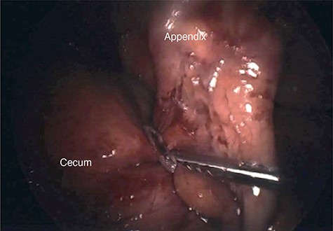 Intraoperative photograph of a thick adhesive band noted to be compressing the base of the appendix.