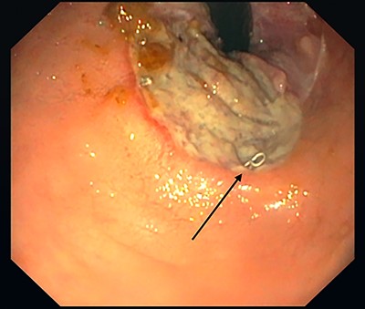 Rectal ulcer, 3.5 cm from the rear circumference. Stapler after hemorrhoidopexy (black arrow).
