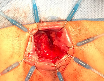 Examination under anaesthetic.