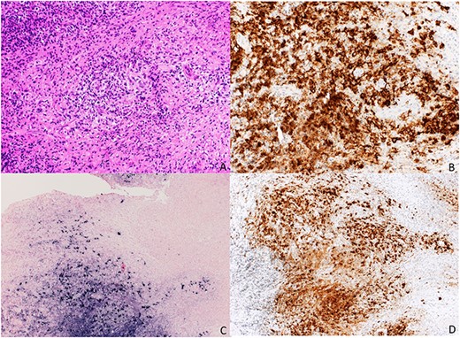 Staining (a) HE; (b) CD 20; (c) EBER; (d) CD 30.