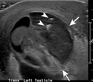 Transverse ultrasound image through the left hemiscrotum shows a complex fluid collection (arrows) including a few internal foci of gas (arrowheads) and debris.