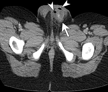 Enhanced axial CT scan image through the scrotum re-demonstrates the complex left hemiscrotal collection (arrows) with internal locules of gas (arrowheads).