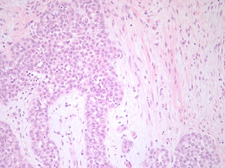 The pathological figure demonstrates LCIS in the background of a fibroadenoma. The image is at ×20 with an H&E stain.