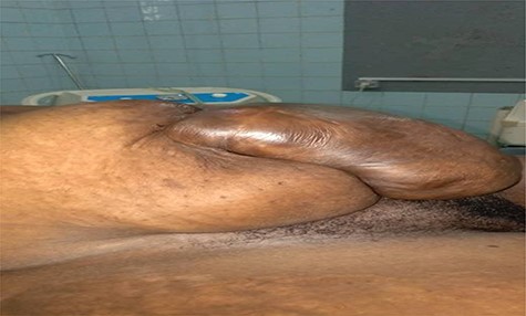 Incisional hernia through a low midline scar of previous surgical operation.