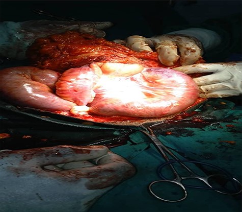 Opened hernia sac with incarcerated bowel loops and obstructed proximal small bowel.