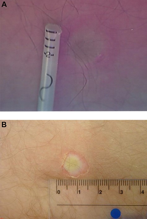 Patient’s burn within 2 hours of surgery. (a) In theatre (mm scale). (b) On ward (numbers in cm).
