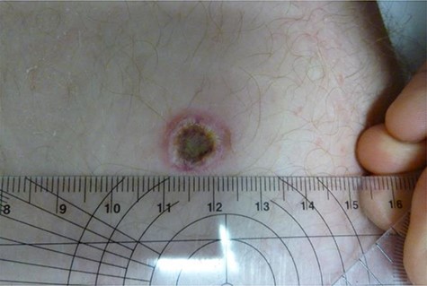 Patient’s burn 6 weeks following surgery.