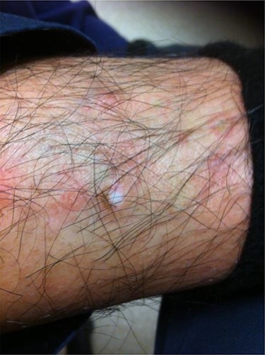 Surgeon’s calf immediately following test.