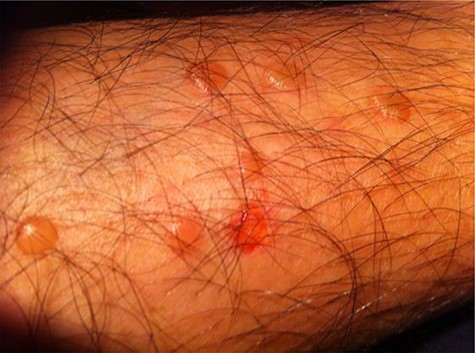 Blistering on surgeon’s calf 4 hours after test.