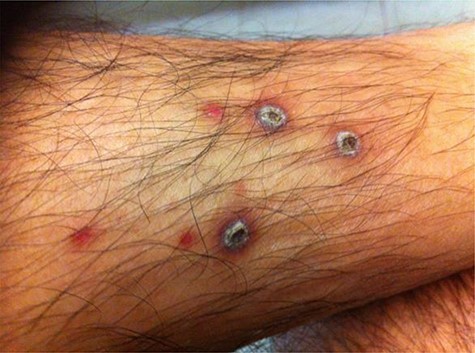 Six weeks after test. The larger scabbed lesions are a result of applying the light lead directly, whereas the smaller lesions result from application of the arthroscope tip.