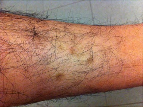 Two years after test.