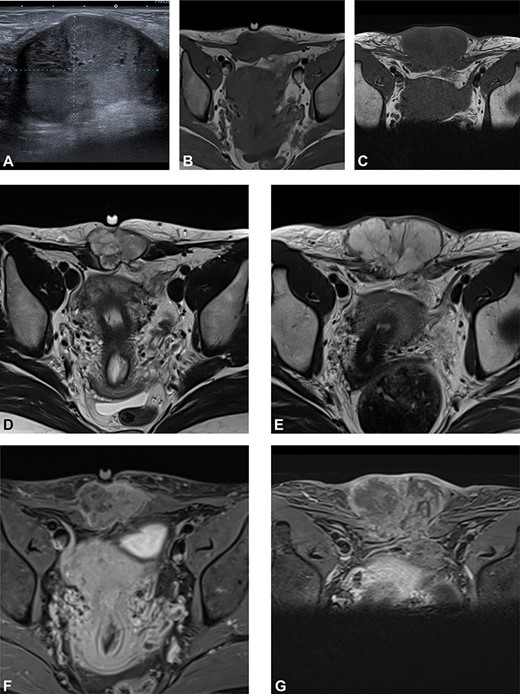 (A) Preoperative ultrasound: ultrasound exam at diagnosis showing a well-defined mass with acoustic enhancement and diffuse ground-glass echoes. (B) Magnetic resonance imaging (MRI) findings: before neoadjuvant radiotherapy (B, D, F) and at the end of the treatment (C, E, G). MRI exams show a well-defined solid mass which presents iso-signal on T1WI (B, C), hyper signal on T2WI (D, E) and heterogeneous enhancement after gadolinium injection (F, G). This mass partially involves both rectus abdominis muscles. A progression, mainly due to necrosis, with an increased size after radiotherapy can be observed.