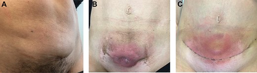 Physical examination. (A) Before neoadjuvant radiotherapy: parietal mass measuring 6 cm at diagnosis and arising from cesarean delivery scar. (B) At the end of radiotherapy: parietal mass measuring 5 cm; a cutaneous fistula and grade 2 radiation-induced epidermitis were observed at the end of the treatment. (C) Postoperative course: after surgery, the patient presented a parietal seroma just above the scar.