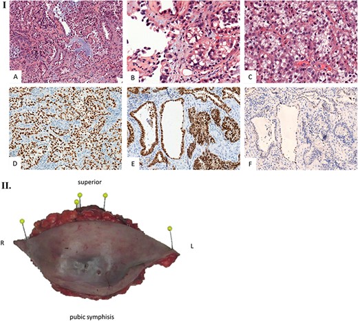 Histological examination. (I) Microscopic examination of the biopsy: A. Glandular and focal papillar pattern , HE stain x200 B. Hobnail morphology of tumoral cells, HE stain x400 C. Nests of neoplastic clear cells, HE stain x400 D. Nuclear immunoreactivity with anti-PAX8 antibody, x200 E. Nuclear immunoreactivity with anti-HNF-1β antibody, x200 F. Wild type pattern with anti-p53 antibody, x200. (II) Surgical specimen. Resection of the parietal mass with free margins after radiotherapy. (III) Microscopic examination of resected specimen: A. Nodular lesion involving dermis and hypodermis, HE x5 B. Hemorrhage, fibrotic and necrotic changes, HE x50 C. Microcystic predominant pattern, HE x100.