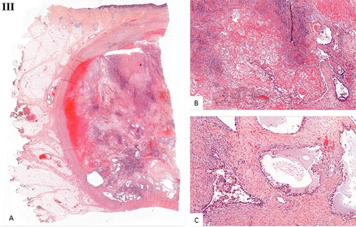 Histological examination. (I) Microscopic examination of the biopsy: A. Glandular and focal papillar pattern , HE stain x200 B. Hobnail morphology of tumoral cells, HE stain x400 C. Nests of neoplastic clear cells, HE stain x400 D. Nuclear immunoreactivity with anti-PAX8 antibody, x200 E. Nuclear immunoreactivity with anti-HNF-1β antibody, x200 F. Wild type pattern with anti-p53 antibody, x200. (II) Surgical specimen. Resection of the parietal mass with free margins after radiotherapy. (III) Microscopic examination of resected specimen: A. Nodular lesion involving dermis and hypodermis, HE x5 B. Hemorrhage, fibrotic and necrotic changes, HE x50 C. Microcystic predominant pattern, HE x100.