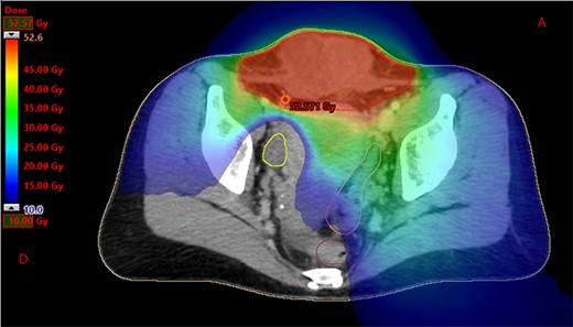 Dosimetry with helicoidal tomotherapy. We can observe the delivered doses from 10 to 52.6 Gy, sparing the right ovary.