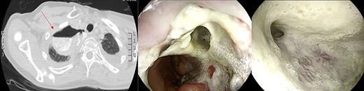 Large anastomotic leakage after minimally invasive esophagectomy opening to a cavity in the pleural space of 8 cm in size.