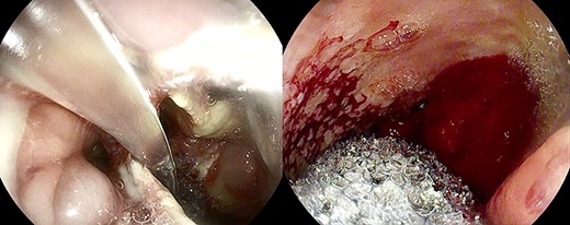 Esosponge placement.