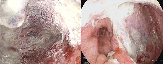 Healthy-appearing granulation tissue and progressive reduction of leak and cavity size.