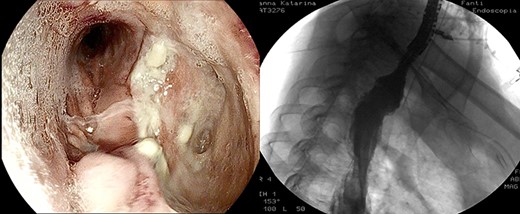 Endoscopic and radiological resolution of the leak.