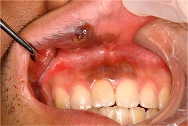 Intraoral photograph of the initial examination. A small mass measured 10 × 8 mm in size at the right side of the upper lip mucosa with a brown–black patch expanding from gingivolabial sulcus to the attached gum of incisive tooth was observed.