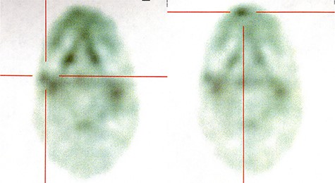 Positron emission tomography/CT finding. 18F-FDG accumulated at both right submaxillary lymph node (left) and right upper lip (right).