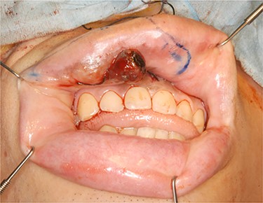Operative finding. The tumor was excised with some orbicularis oris muscle including the oral mucosa, gingiva and alveolar bone from the right canine tooth to the left incisor.